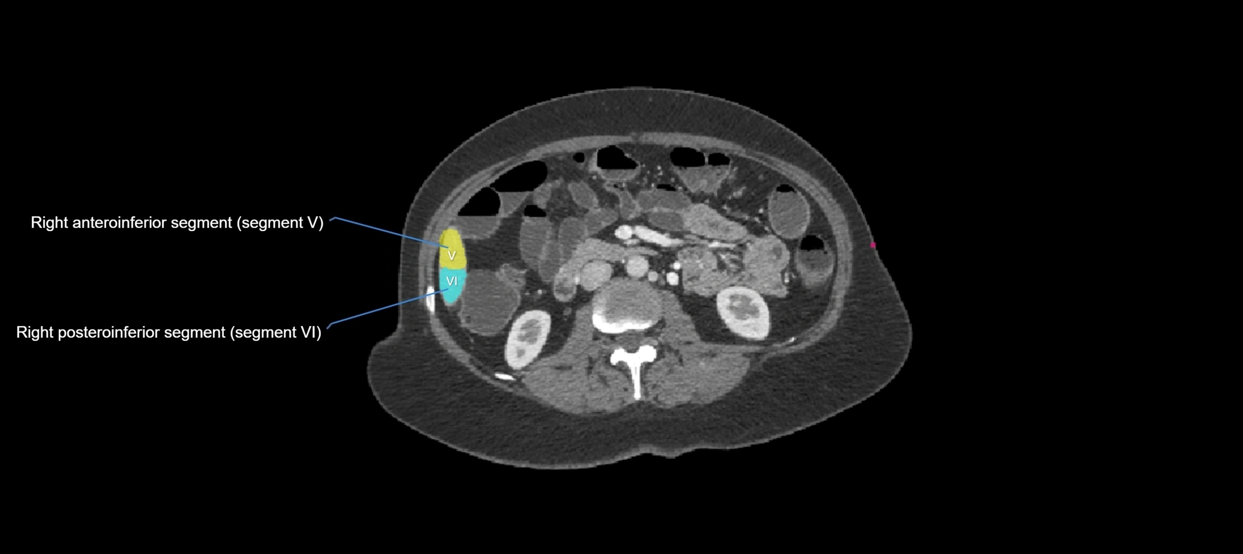 CT liver segments axial cross sectional anatomy labelled image-00007.webp